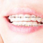 歯科矯正まとめ