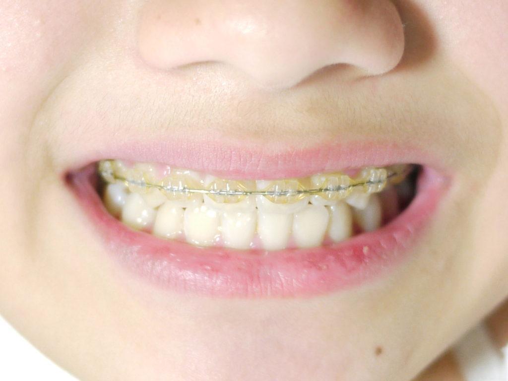 矯正歯科まとめ リテーナーはメンテナンスの要 装置の重要な役割や扱い方を解説