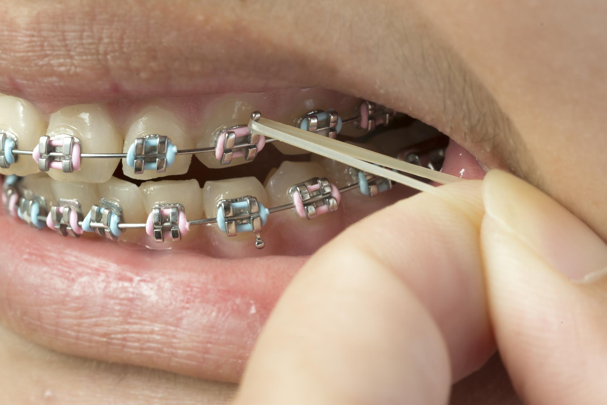 矯正歯科まとめ 歯並びを直したい人へ 4つの矯正治療方法と日頃から気をつけたい習慣を紹介