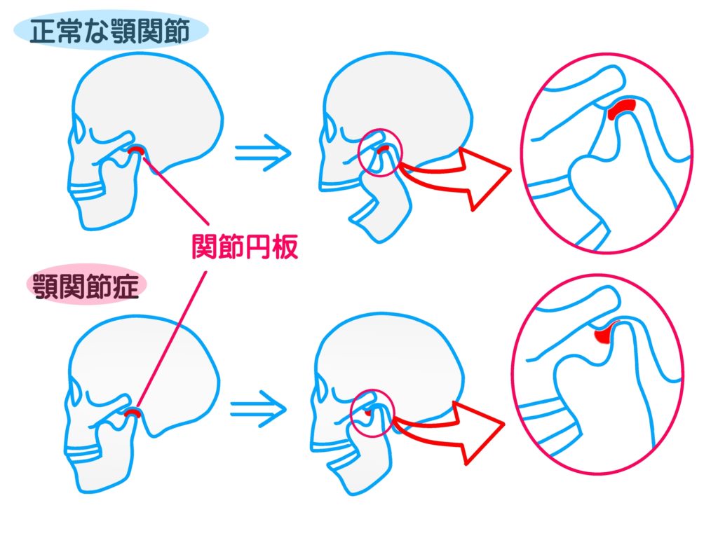 顎関節症の図解