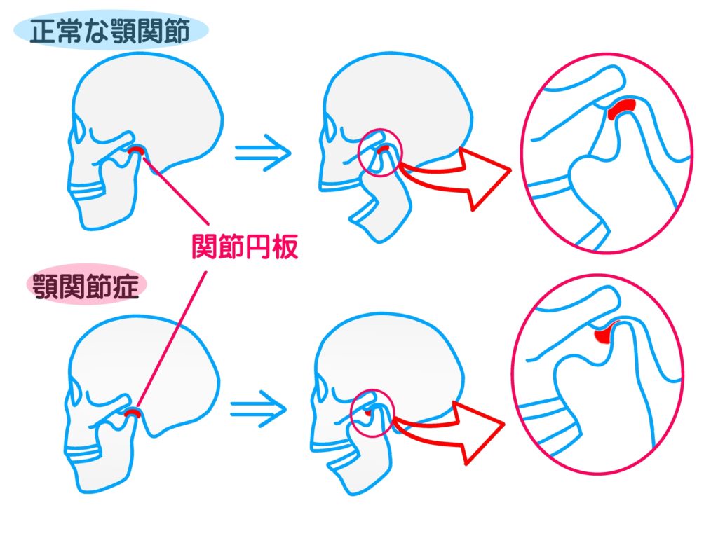 顎関節症の原因は何ですか?