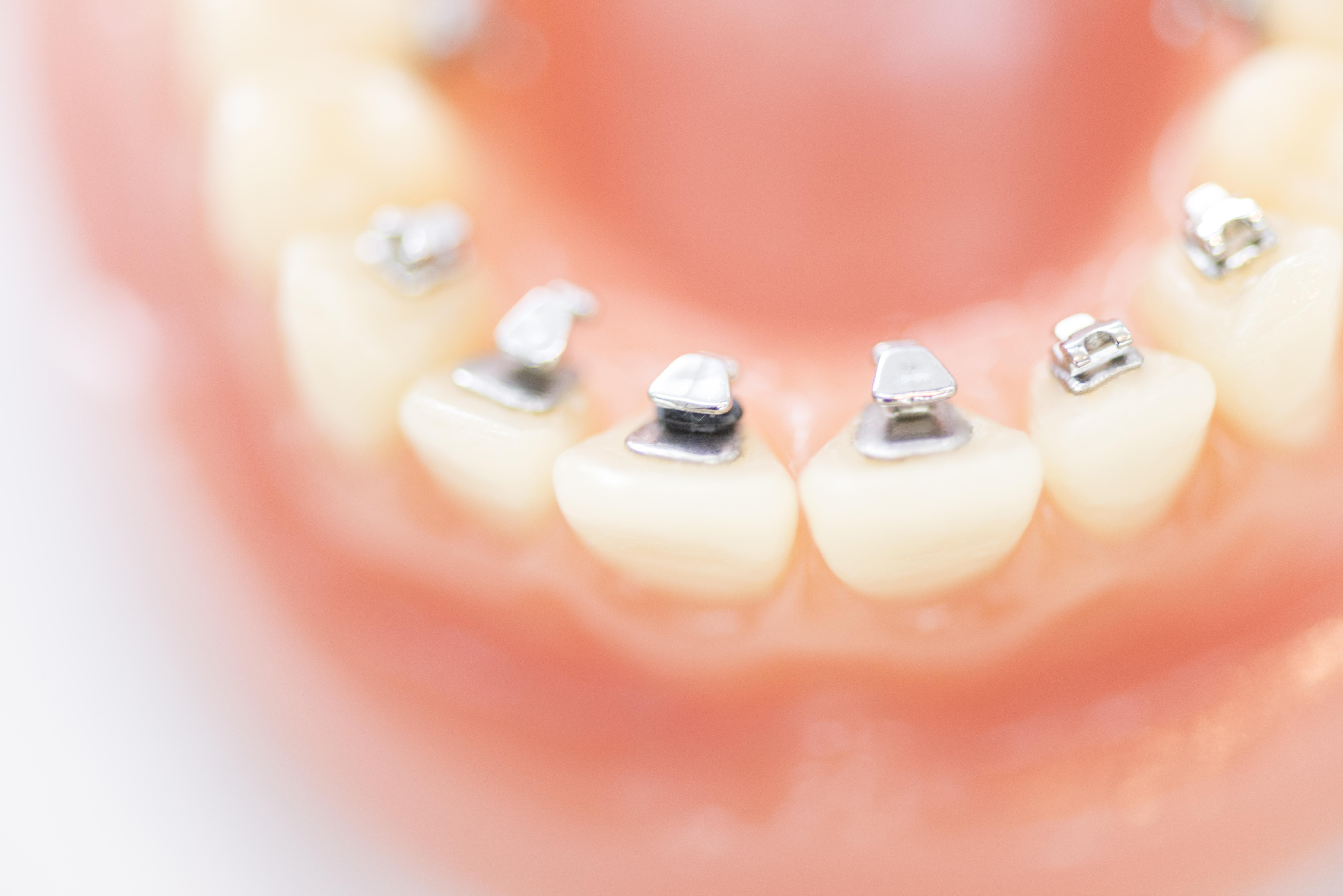 矯正歯科まとめ 裏側矯正は滑舌が悪くなる その原因と対処法