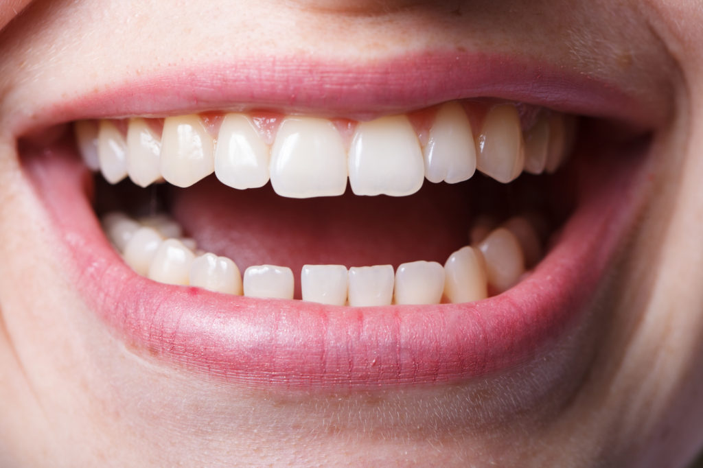 部分矯正が向いている人の歯の写真